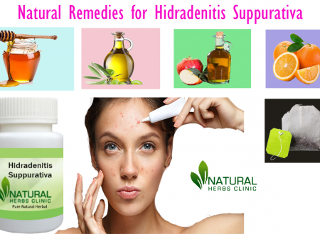 Helpful Natural Remedies for Hidradenitis Suppurativa