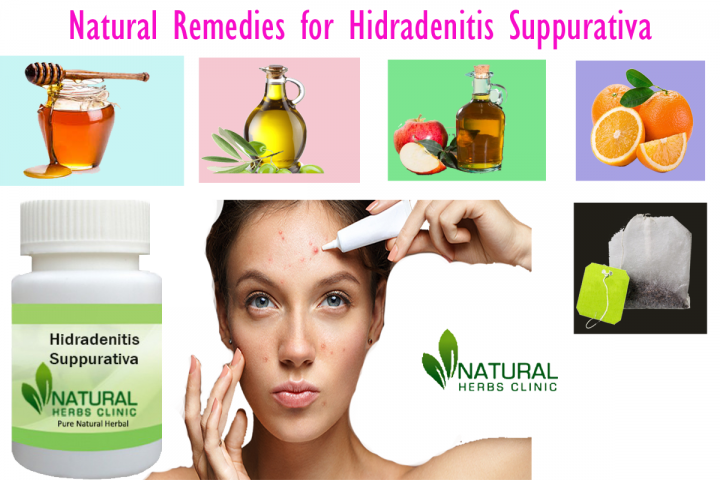 Natural Remedies for Hidradenitis Suppurativa