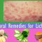 Natural Remedies for Lichen Planus Complete Cure